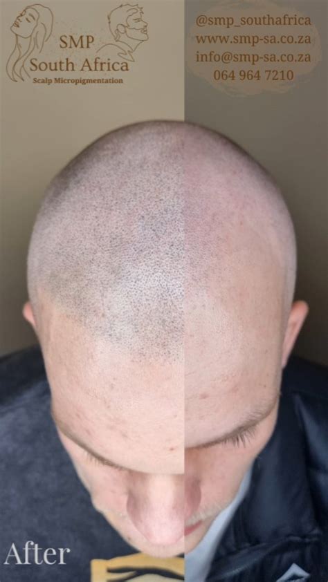 scalp micropigmentation sa|Scalp Micropigmentation in South Africa • Check Prices & Reviews.